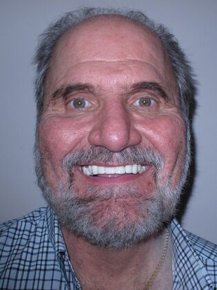 Full Mouth Implants: Joseph