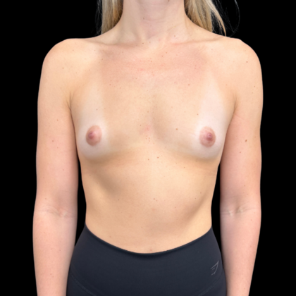Breast Augmentation Case 1 - Before