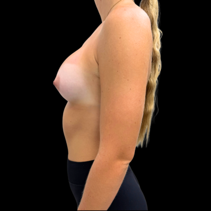 Breast Augmentation: Case 1 - After