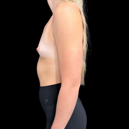 Breast Augmentation: Case 1 - Before