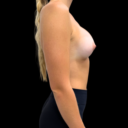 Breast Augmentation: Case 1 - After