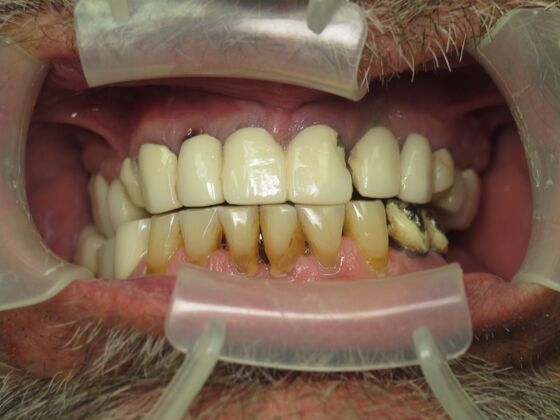 Full Mouth Implants: Joseph