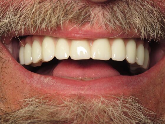 Full Mouth Implants: Joseph