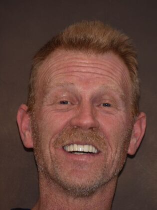 Full Mouth Implants Sean’s Upper Dental Implants After Missing Teeth, Bonds, and Crowns - After