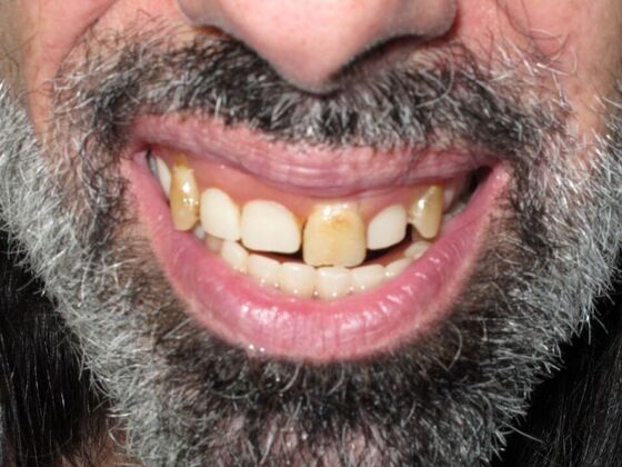 Full Mouth Implants: Nicholas Stopped Hiding His Smile After Full Mouth Implants - Before