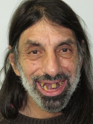 Full Mouth Implants Nicholas Stopped Hiding His Smile After Full Mouth Implants - Before
