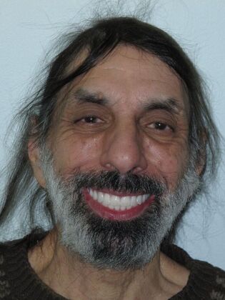 Full Mouth Implants Nicholas Stopped Hiding His Smile After Full Mouth Implants - After