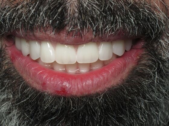 Full Mouth Implants: Nicholas Stopped Hiding His Smile After Full Mouth Implants - After