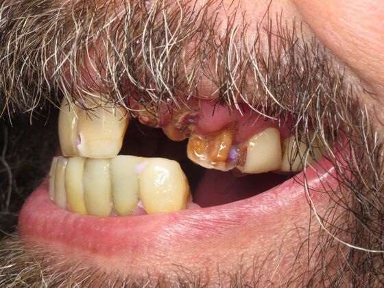 Full Mouth Implants: Full Upper and Lower Implants for a Powerful Smile Transformation - Before