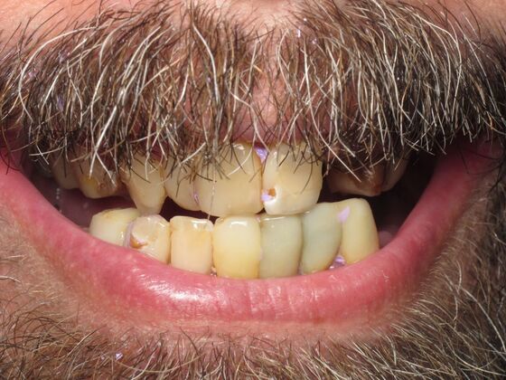 Full Mouth Implants: Full Upper and Lower Implants for a Powerful Smile Transformation - Before