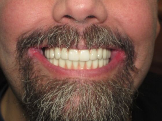 Full Mouth Implants: Full Upper and Lower Implants for a Powerful Smile Transformation - After