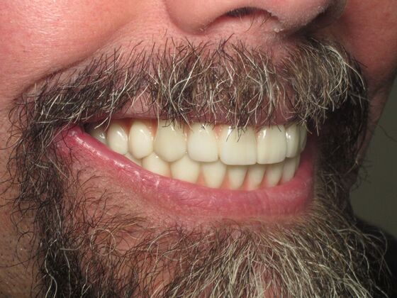 Full Mouth Implants: Full Upper and Lower Implants for a Powerful Smile Transformation - After
