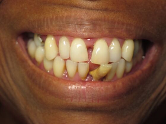 Full Mouth Implants: Lower Teeth in a Day and Upper Implants for a Rebuilt Smile - Before