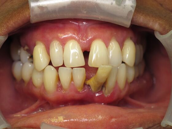 Full Mouth Implants: Lower Teeth in a Day and Upper Implants for a Rebuilt Smile - Before