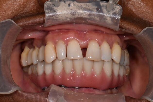 Full Mouth Implants: Lower Teeth in a Day and Upper Implants for a Rebuilt Smile - After