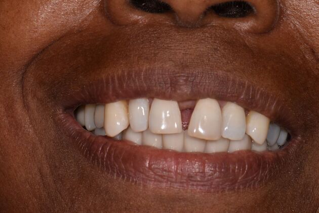 Full Mouth Implants: Lower Teeth in a Day and Upper Implants for a Rebuilt Smile - After