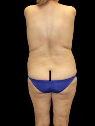 Brazilian Butt Lift Case 34 - Before
