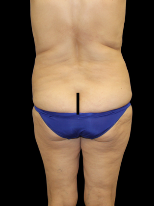 Brazilian Butt Lift BBL 22 - Before