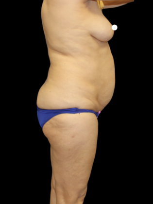Brazilian Butt Lift: Case 34 - Before