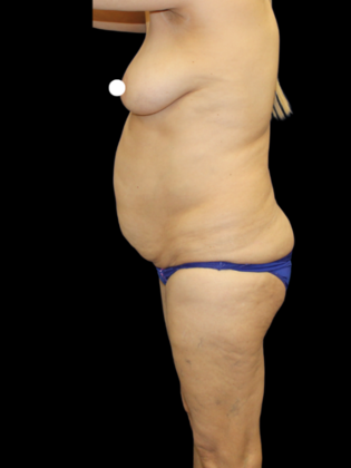 Brazilian Butt Lift: Case 34 - Before