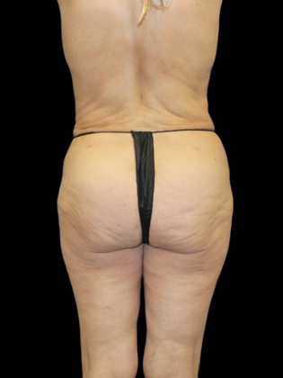 Brazilian Butt Lift BBL 22 - After