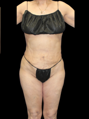 Brazilian Butt Lift: Case 34 - After