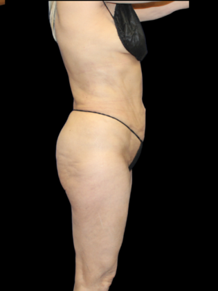 Brazilian Butt Lift: Case 34 - After