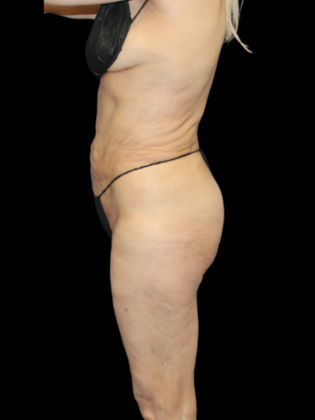Brazilian Butt Lift: Case 34 - After