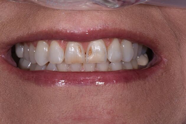 Dr. Duncans Work : Sara Kimbrell - Before