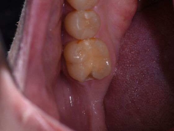 Dr. Duncans Work  Caleb Herndon - Before