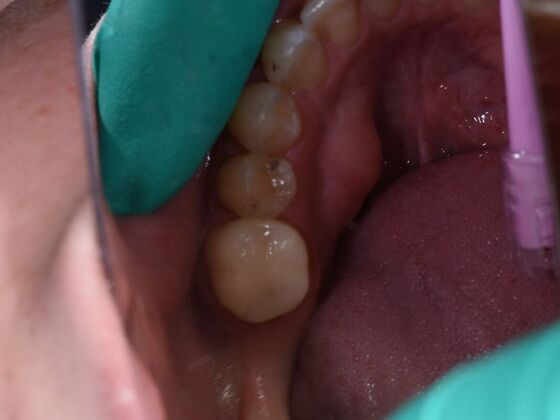 Dr. Duncans Work  Caleb Herndon - After