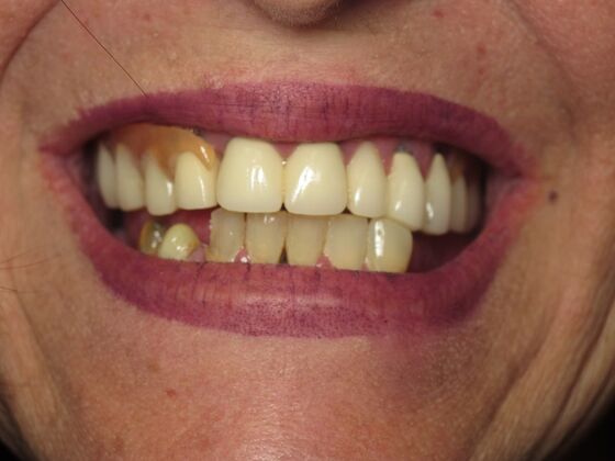 Full Mouth Implants: Lower Teeth in a Day for a Fuller Smile and More Confidence - Before