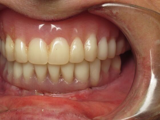 Full Mouth Implants: Lower Teeth in a Day for a Fuller Smile and More Confidence - After