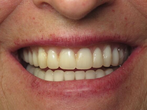 Full Mouth Implants: Lower Teeth in a Day for a Fuller Smile and More Confidence - After