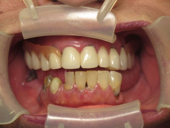 Full Mouth Implants: Lower Teeth in a Day for a Fuller Smile and More Confidence - Before