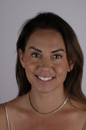 Our Smile Transformations Alissa - Before