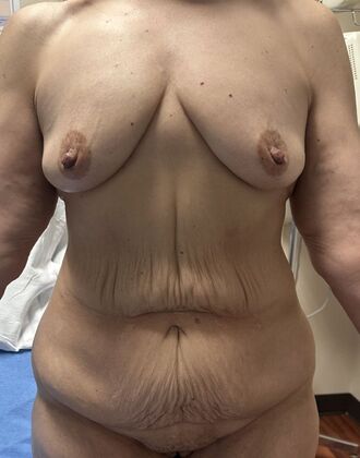 Mommy Makeover Case 382 - Before