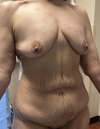 Mommy Makeover: Case 382 - Before