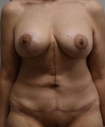 Mommy Makeover Case 382 - After