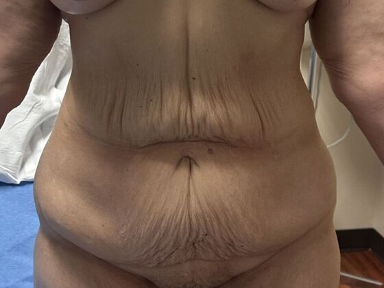 Tummy Tuck (Abdominoplasty): Case 598 - Before