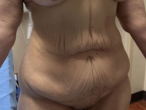 Tummy Tuck (Abdominoplasty): Case 598 - Before