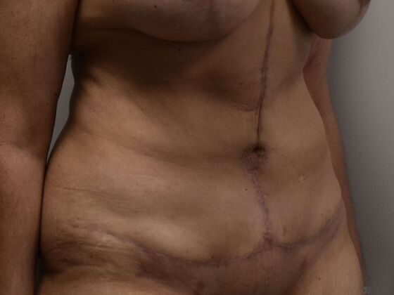 Tummy Tuck (Abdominoplasty): Case 598 - After