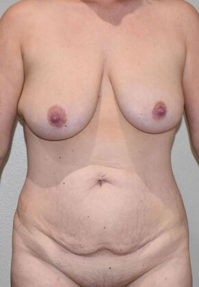 Mommy Makeover Case 383 - Before