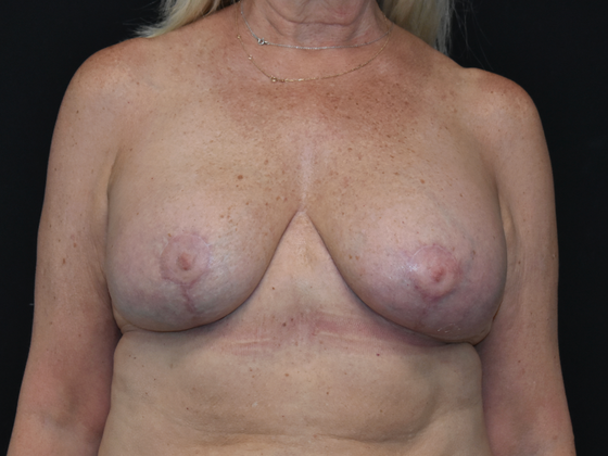 Mastopexy with Augmentation Case 23 - After