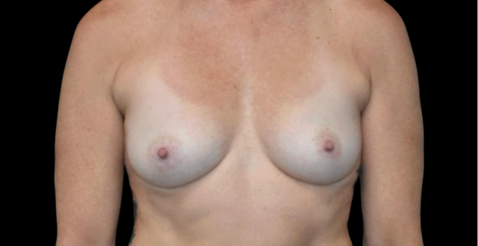 Breast Augmentation Case 31 - Before