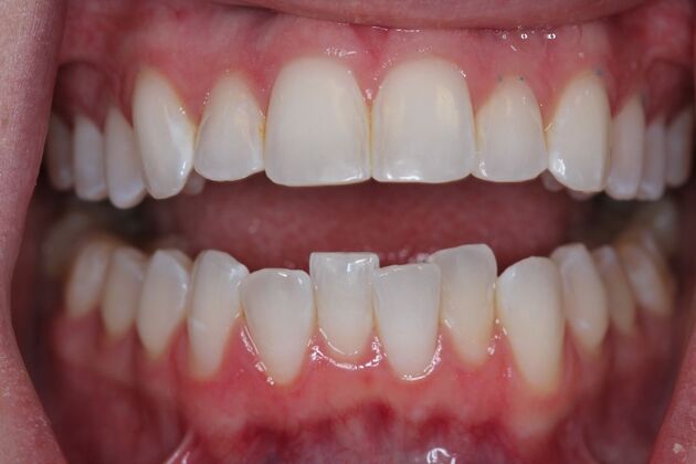 Invisalign Case 11 - Before