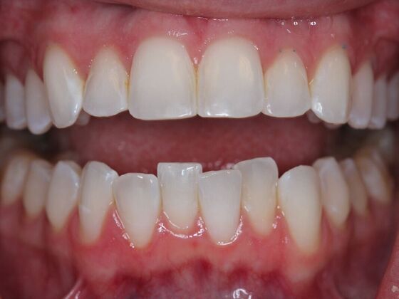 Invisalign Case 11 - Before