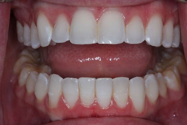 Invisalign Case 11 - After