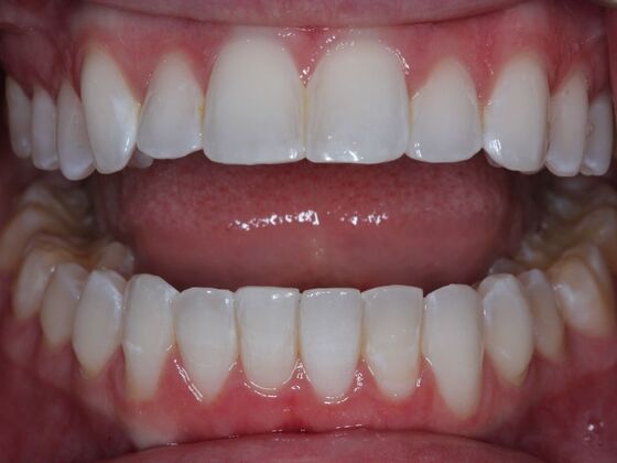 Invisalign Cases
