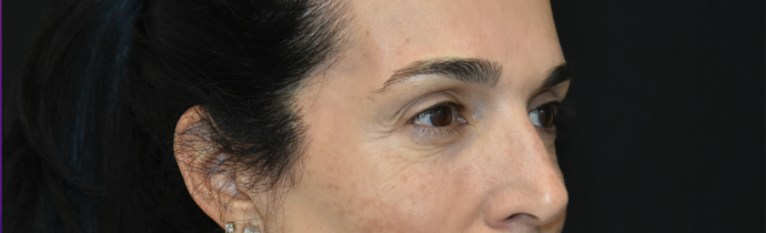Eye Lift (Blepharoplasty) Case 5 - Before